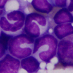 非再生性免疫介在性貧血 (NRIMA)・赤芽球癆 (PRCA)