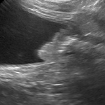 膀胱・尿道の腫瘍