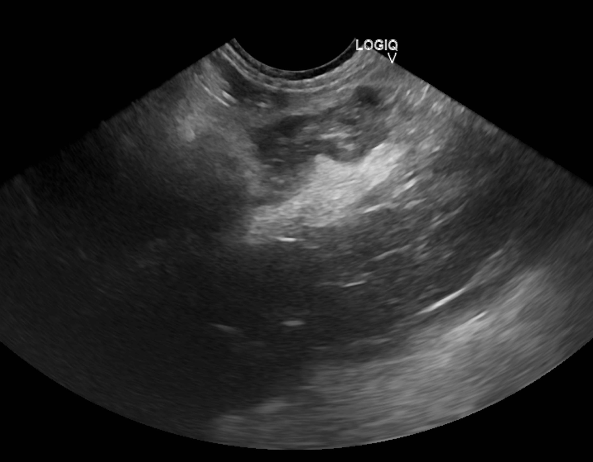 超音波検査で見える膵炎の所見