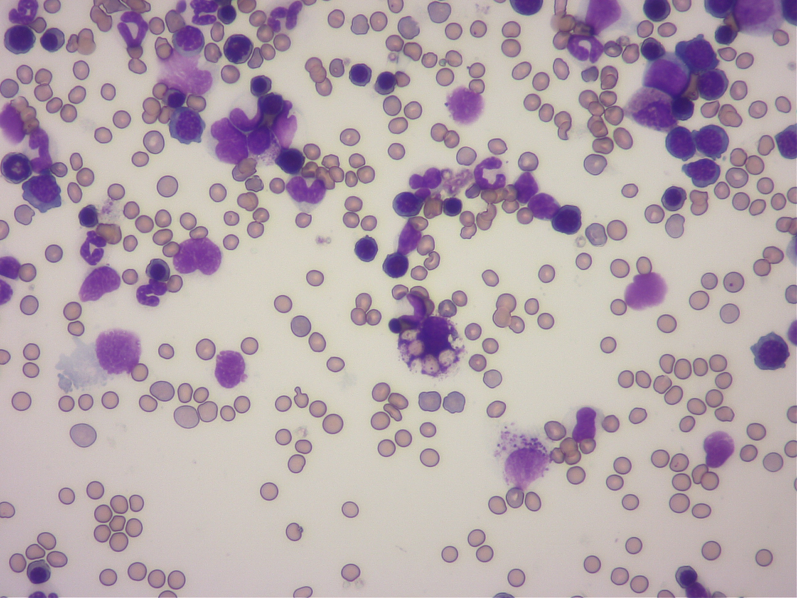 骨髄検査で骨髄内に浸潤した肥満細胞が赤血球を貪食している像