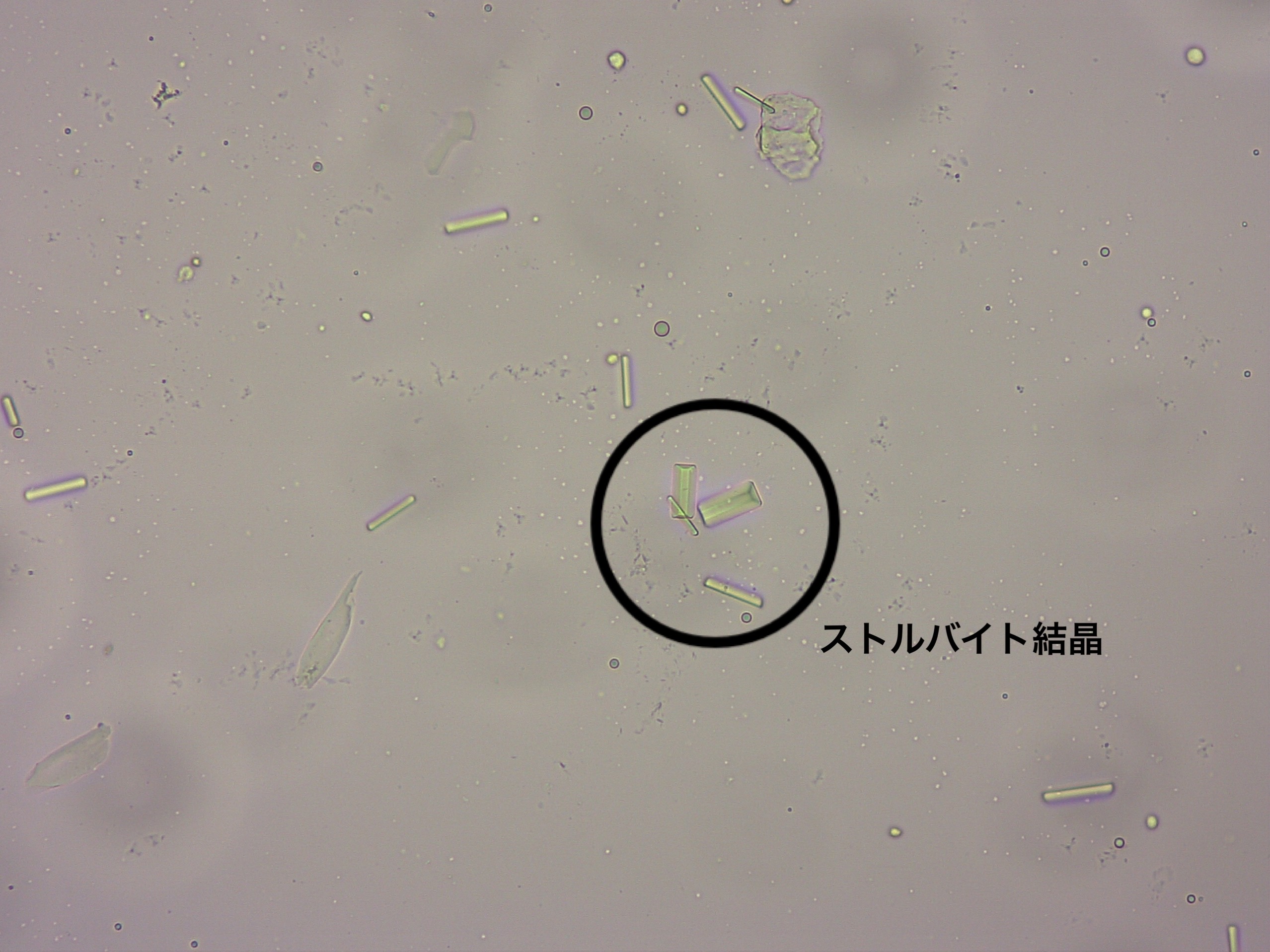 ストルバイト結晶尿