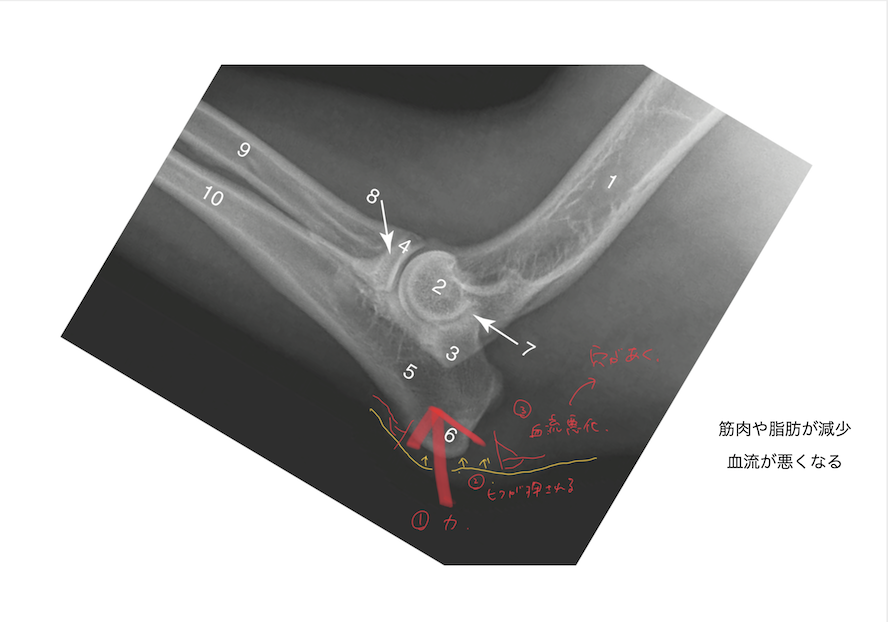 褥瘡が起こりやすい場所のレントゲン画像