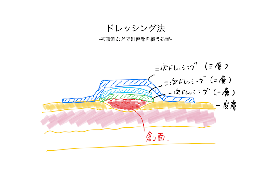 ドレッシング法