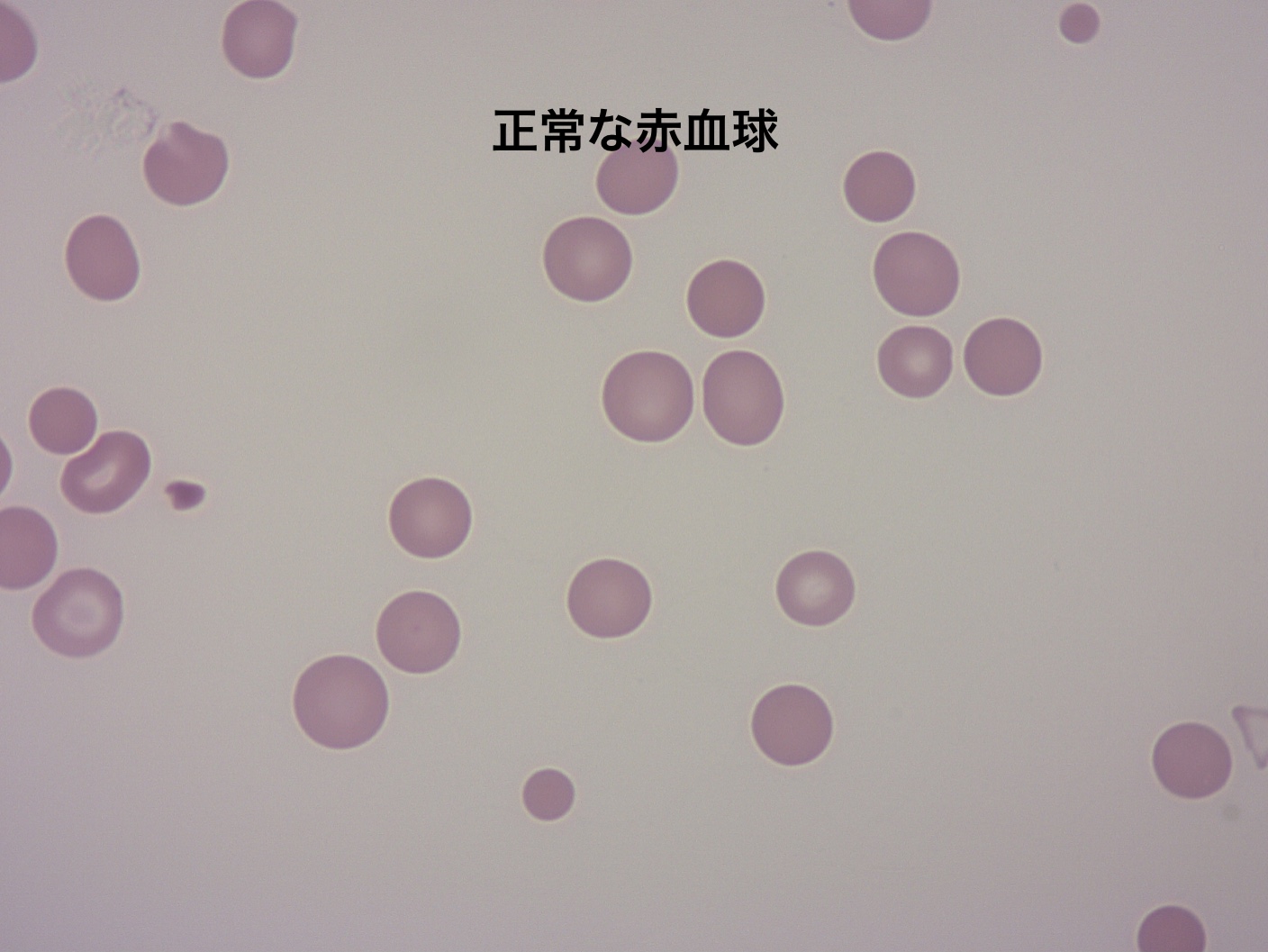正常な赤血球