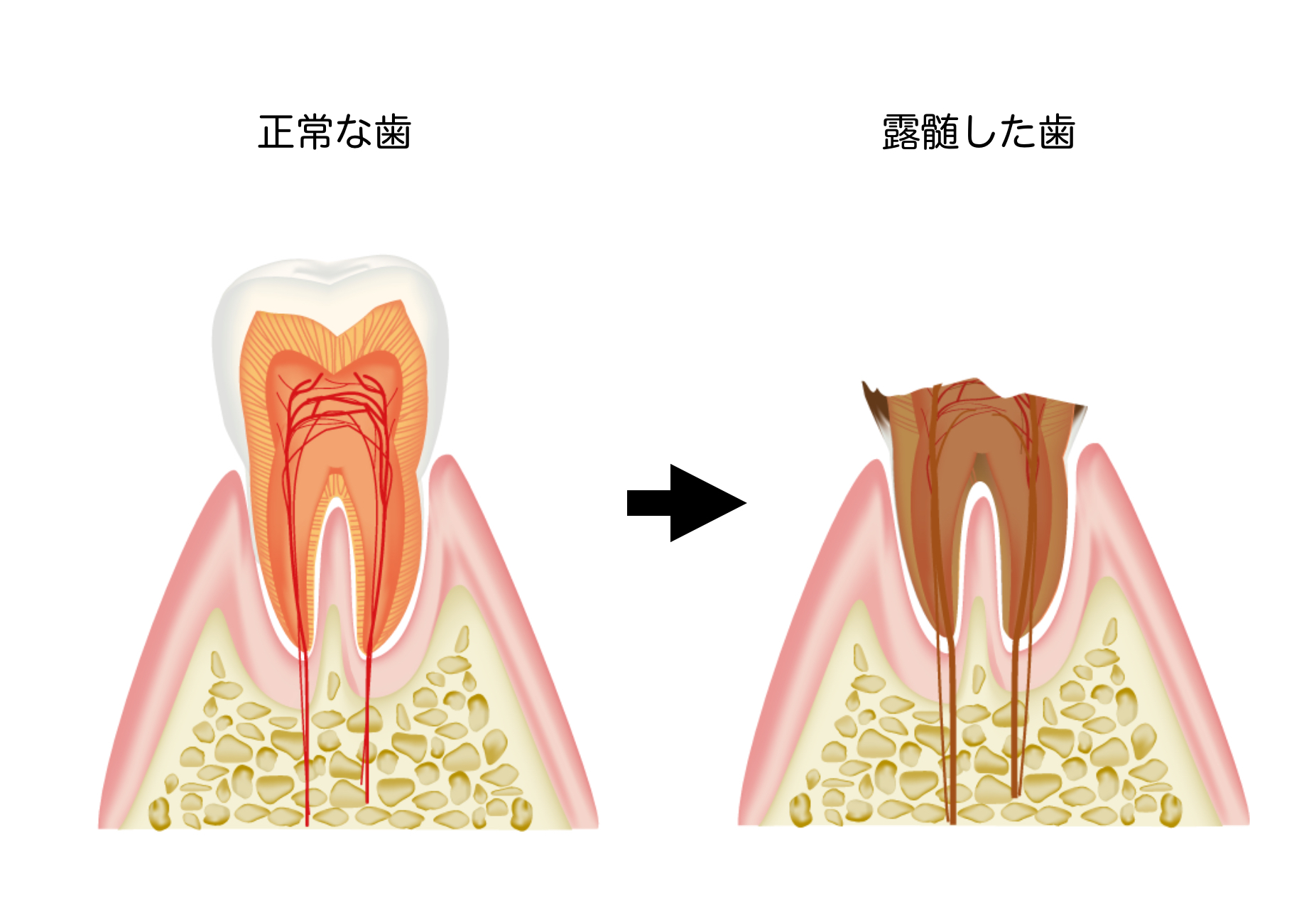 正常な歯と露髄した歯