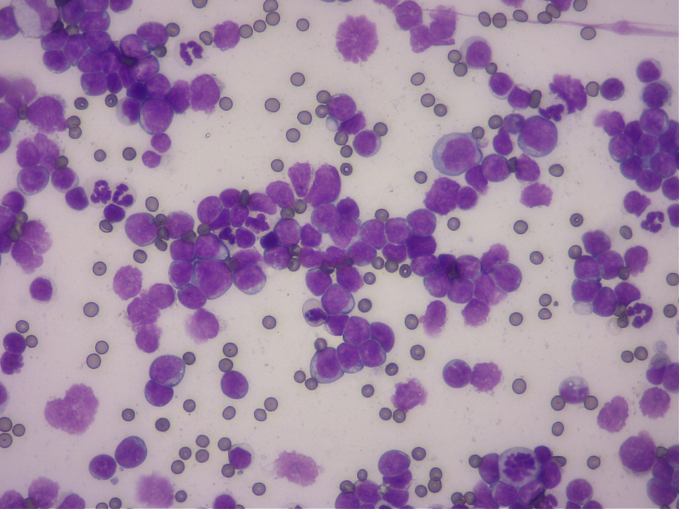 リンパ腫の骨髄検査