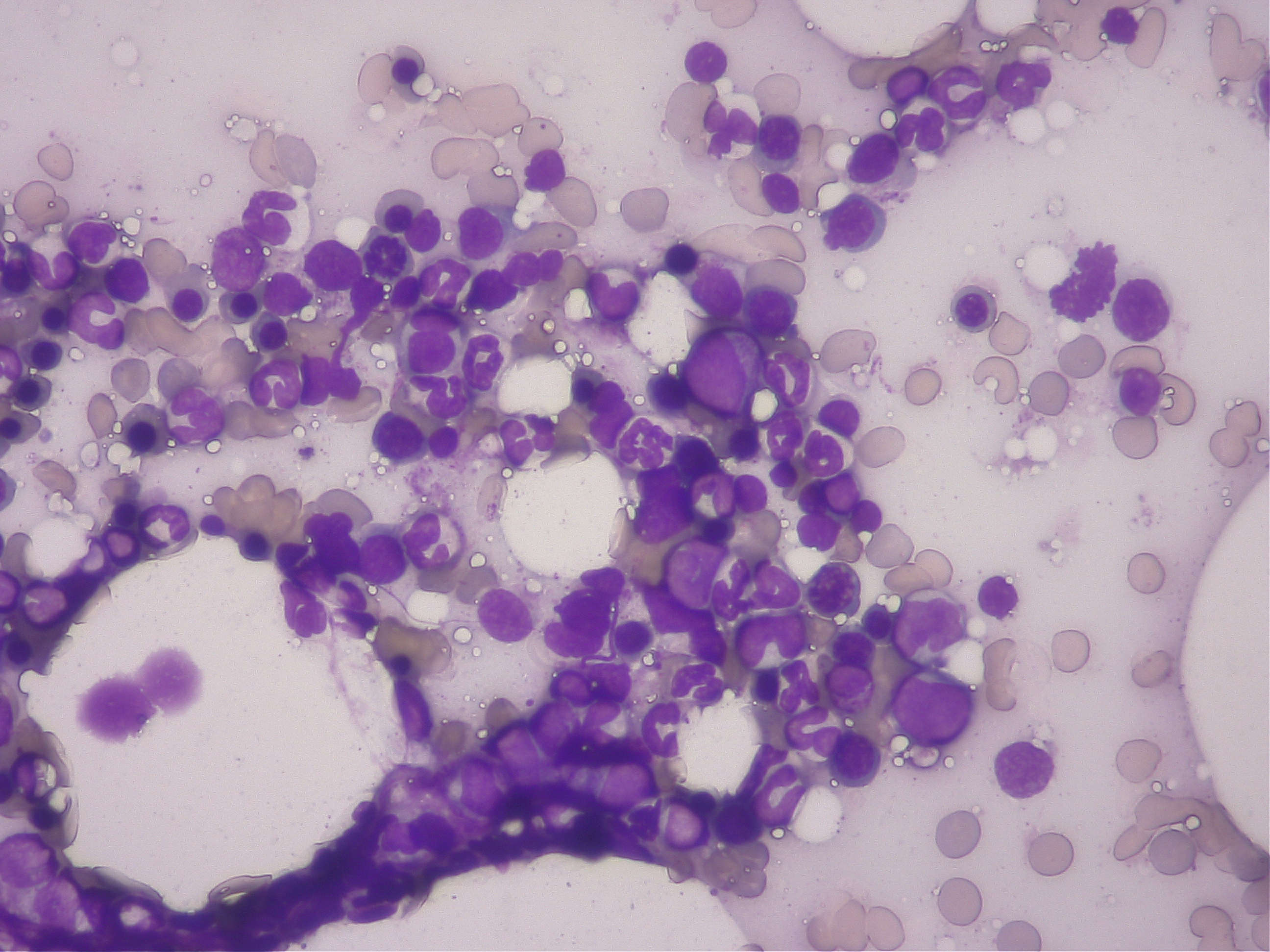 三系統減少症の骨髄検査