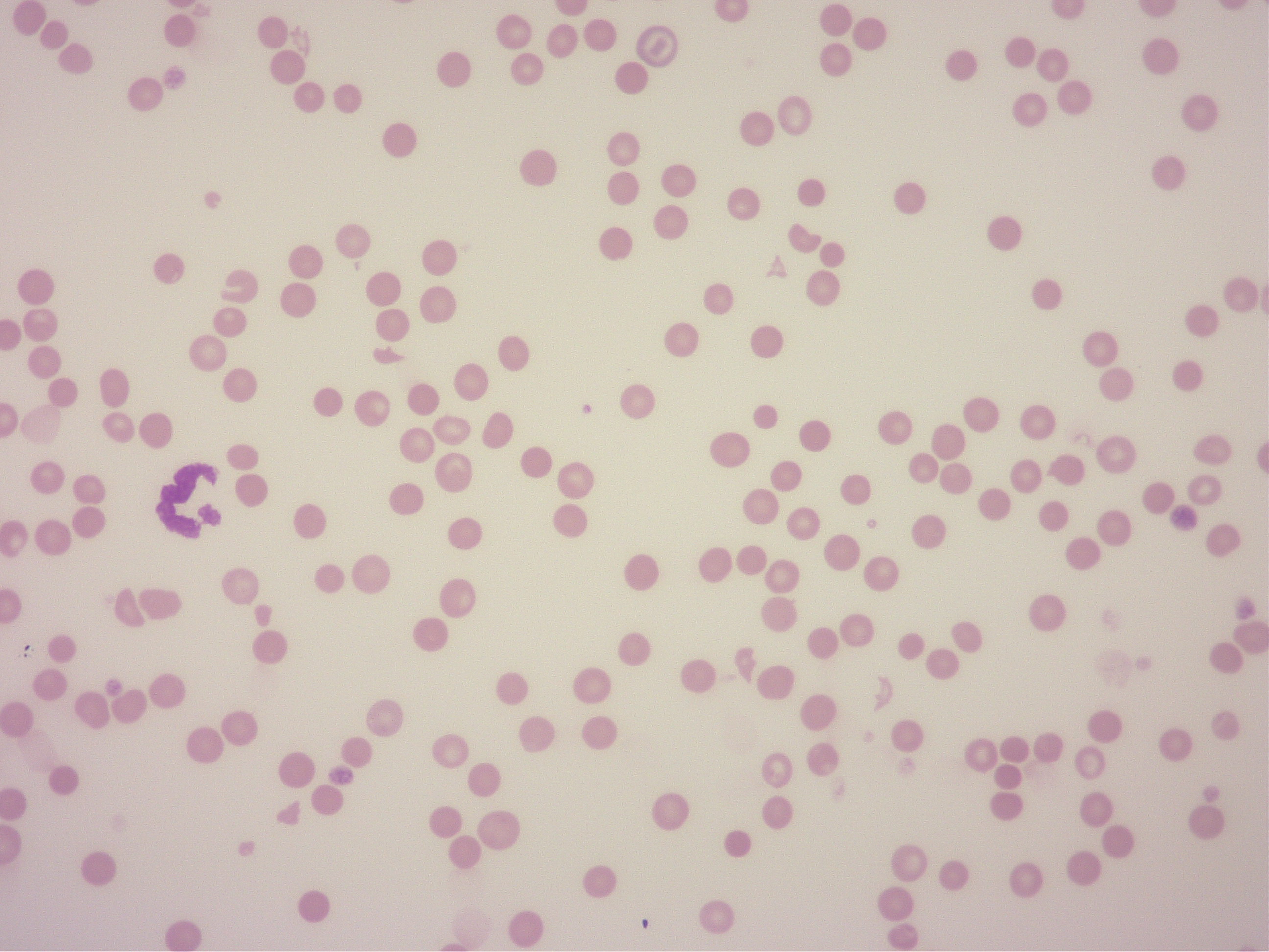 破砕赤血球の血液塗沫検査