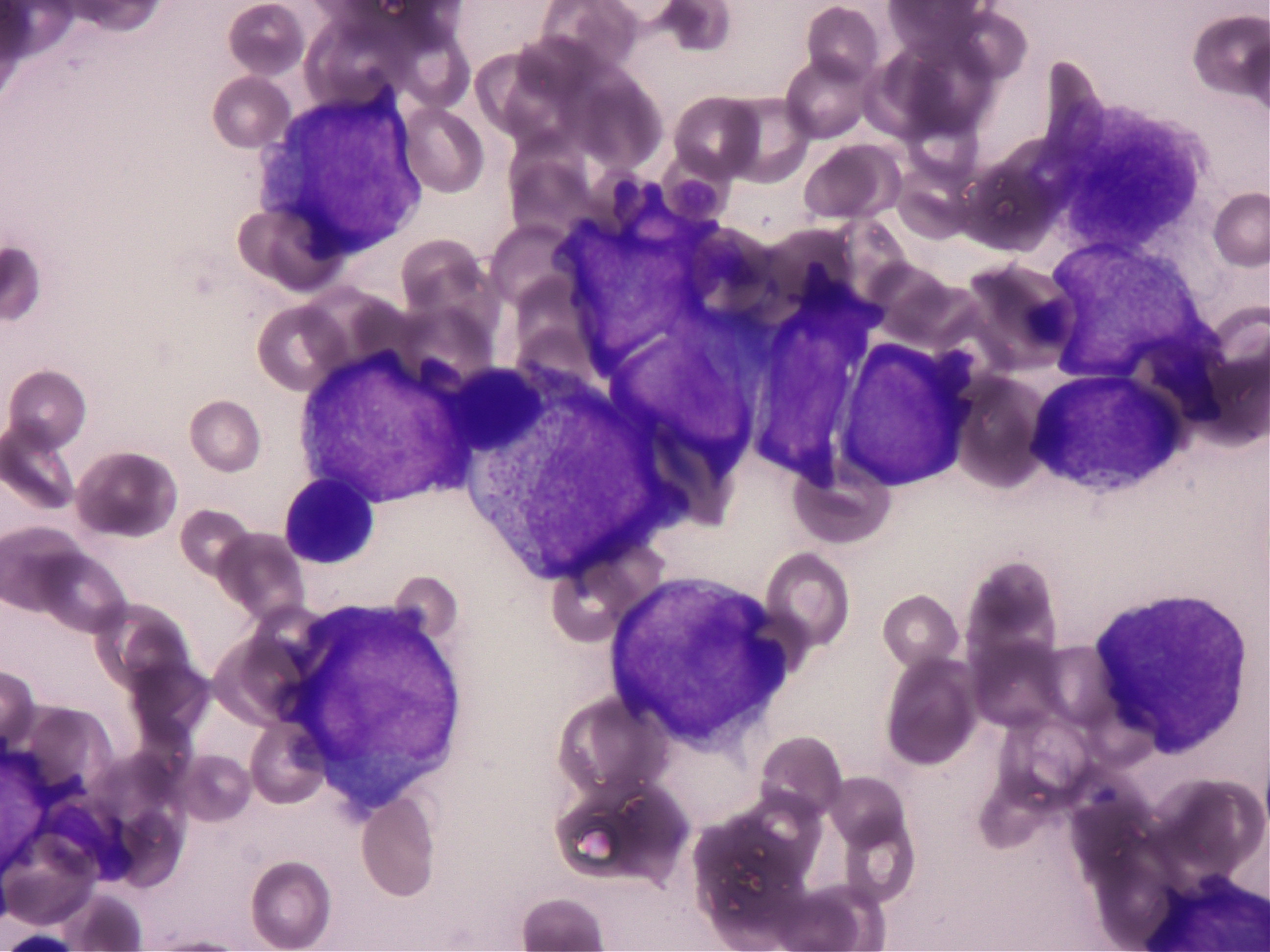 LGLリンパ腫の細胞診