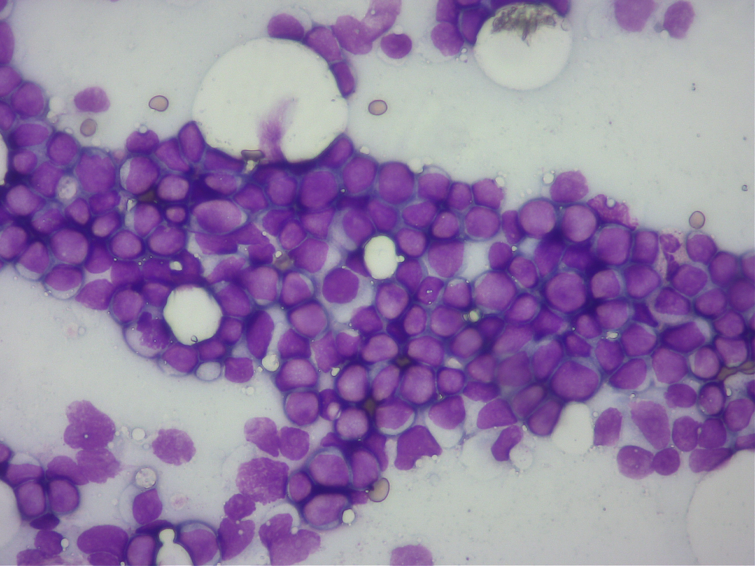 リンパ腫の細胞