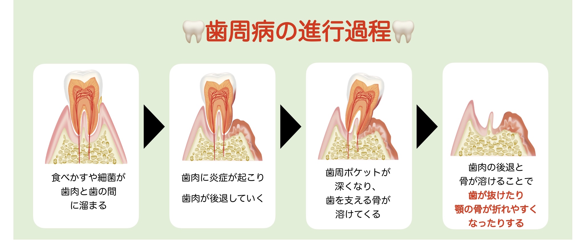 歯周病の進行過程